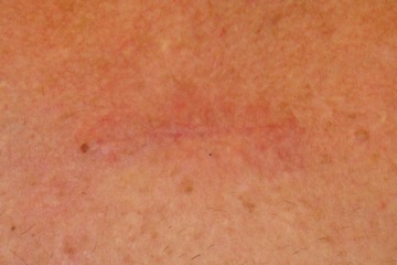 skin healing 001 picture