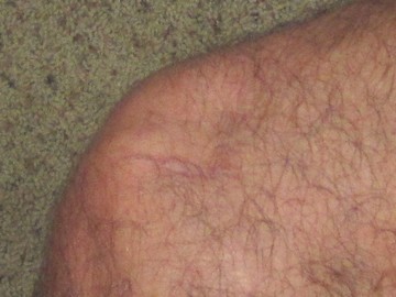 healed knee pic